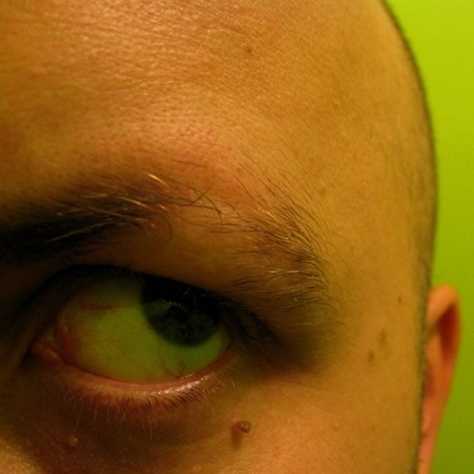 alopecia-areata